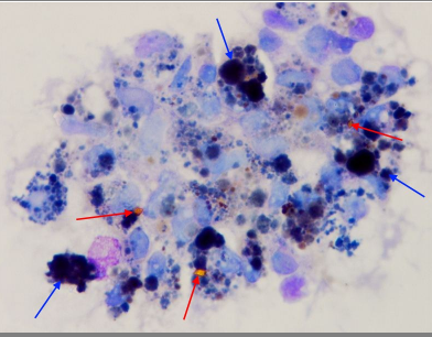 <p>Upon centrifugation, a cerebrospinal fluid (CSF) sample supernatant exhibited xanthochromia. The image is a Wright-Giemsa stained smear that was made from that CSF sample. What condition is probably related to these macroscopic and microscopic findings?</p><p></p><p>Previous subarachnoid hemorrhage</p><p>Traumatic tap</p><p>Leukemia</p><p>This is a normal microscopic finding for a CSF specimen</p>