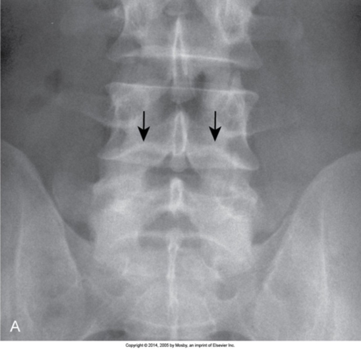 <p>Nuclear impression clinical significance</p>