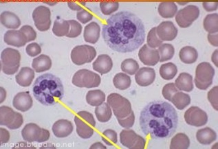 <p>Nucleus contains more than 5 lobes or segments</p><p>Indicates cell has been in circulation for awhile </p>