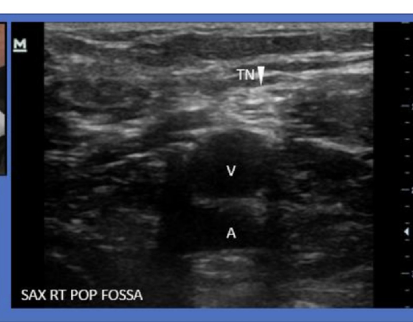 <p>popliteal artery/vein and tibial nerve</p>