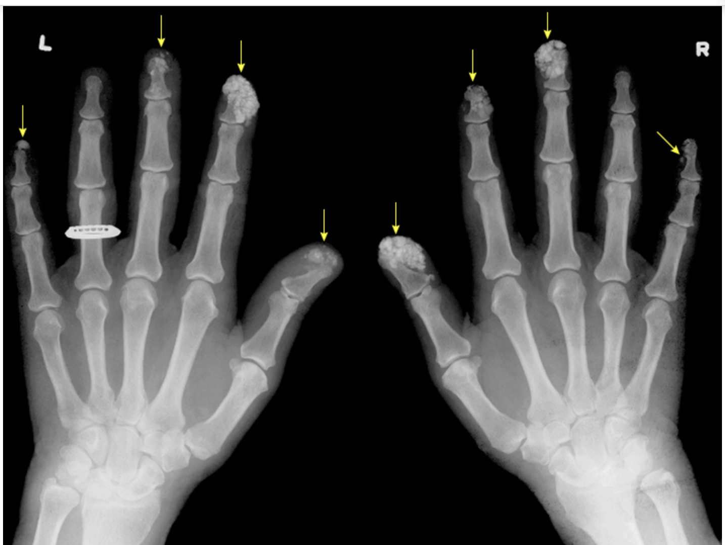 <p>Subcutaneous Ca2+ deposits that can be found on the fingertips and extensor surfaces (forearms, patellas) - no effective treatment</p>