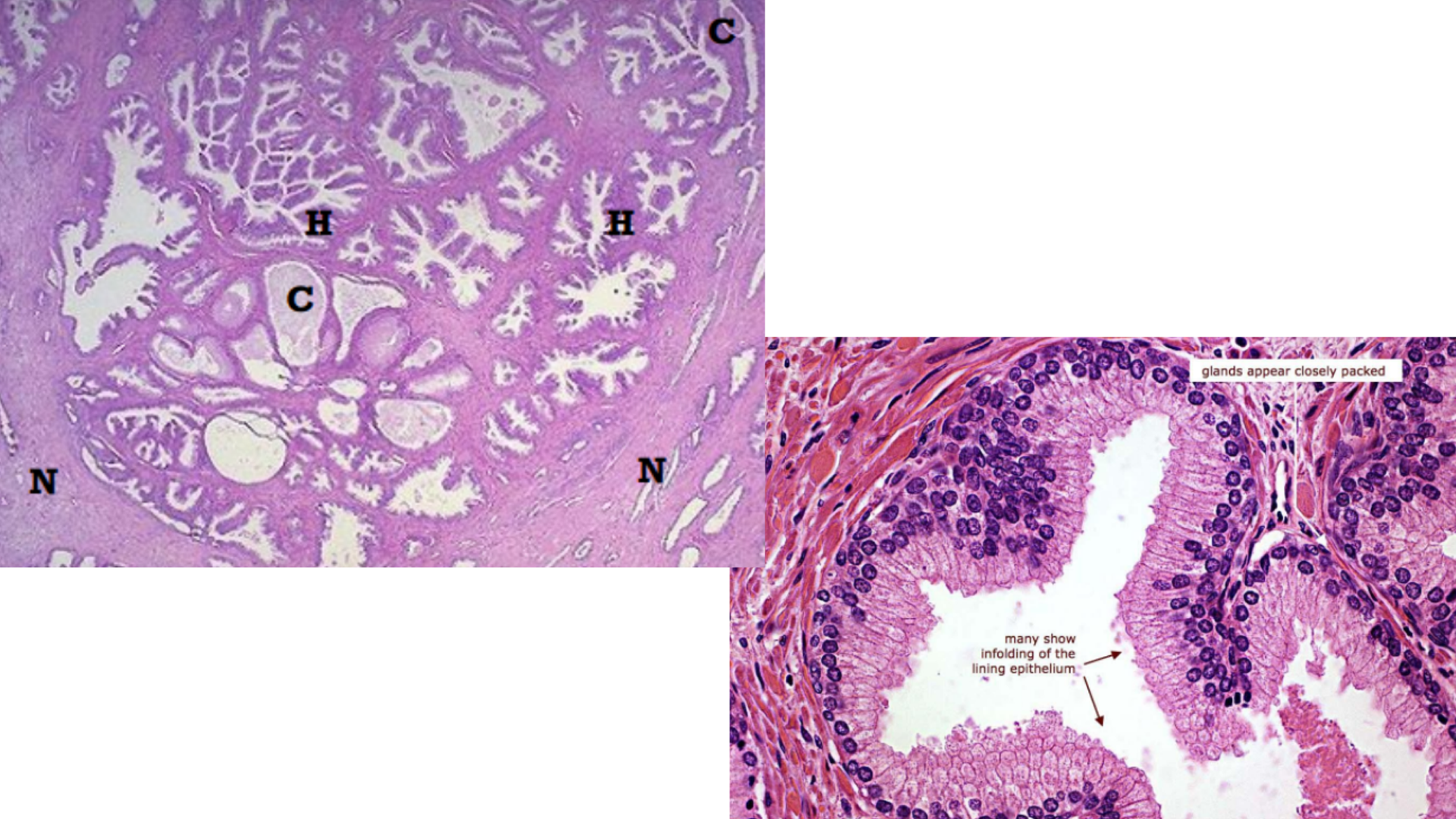 <p>Benign Prostatic Hyperplasia</p>