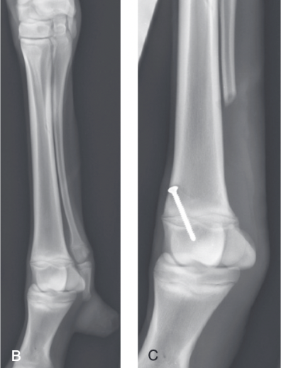 <ul><li><p><span>Most frequently described congenital phalangeal malformation in the horse</span></p></li><li><p><span>In 80% of the cases, the supernumerary digit develops on the medial aspect of the forelimb</span></p></li><li><p><span>Usually digit represent an atavistic form of a regular small MC/MT bone</span></p></li><li><p><span>Supernumary MC/MT and digit should be removed to improve the cosmetic appearance and to prevent injury to the digit</span></p></li><li><p><span>Incision made directly over the supernumary digit starting at the midcannon bone and continuing distal up to the supplementary hoof</span></p></li><li><p><span>Supernumary digit has extensor and flexor tendons, a suspensory ligament, and sesamoid bones as well as vessels and nerves</span></p></li><li><p><span>Vessels are ligated and transected together with the tendons as far proximal as possible</span></p></li><li><p><span>Osteotomy of the digit (usually MCII) is performed at its middle part with an osteotome or oscillating saw</span></p></li></ul>