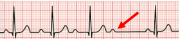 <ul><li><p>progressive lengthening of PR interval, then missed QRS complex</p></li></ul><p></p>
