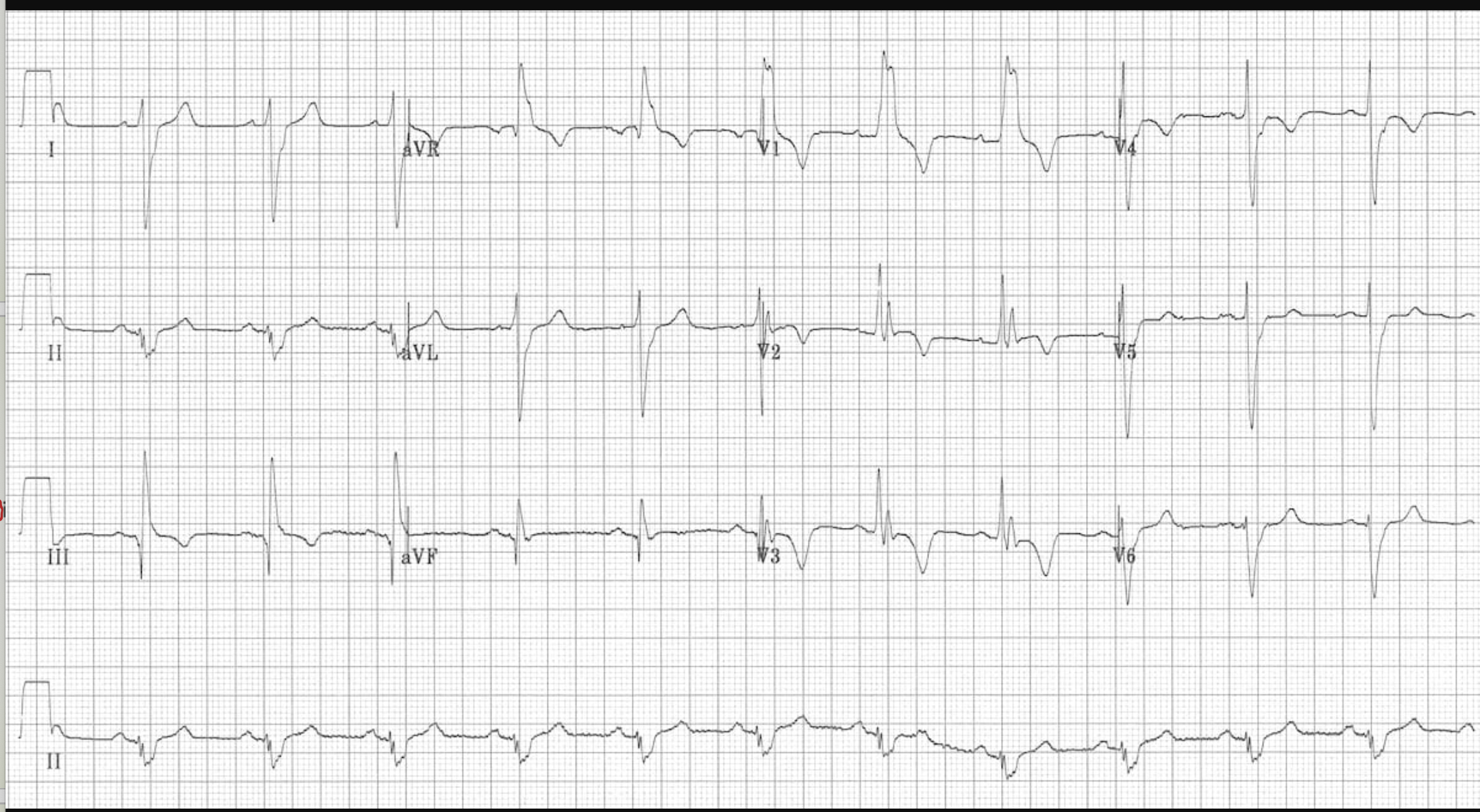 <p>Patient presents to the ER with a stabbing chest pain radiating through to the back. He reports pain is exacerbated with deep inspiration and that he is coughing up blood. Hx is positive for a PE 4 years ago. Vitals are stable with the exception of HR 125, RR 27. Your amazing, awesome, beautiful ED tech hands you this EKG. Based on this (his wells criteria is like 7) what should you order?</p>