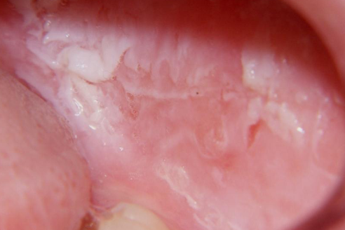 <p>asymptomatic white corrugated keratotic surface on <strong>BUCCAL</strong> mucosa present since <strong>CHILDHOOD</strong></p>