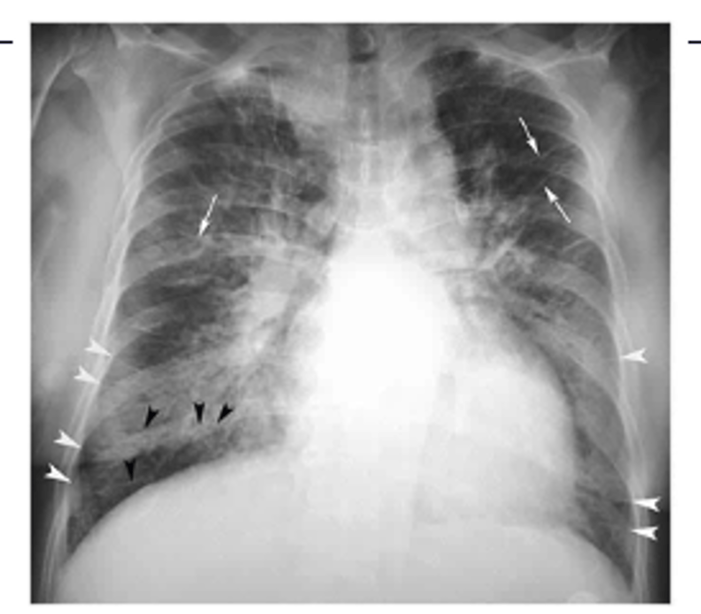 <p>Kerley lines --&gt; interstitial pulm edema</p>