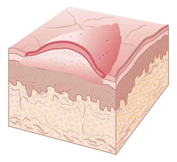 <p>form due to excess collagen production after injury</p>
