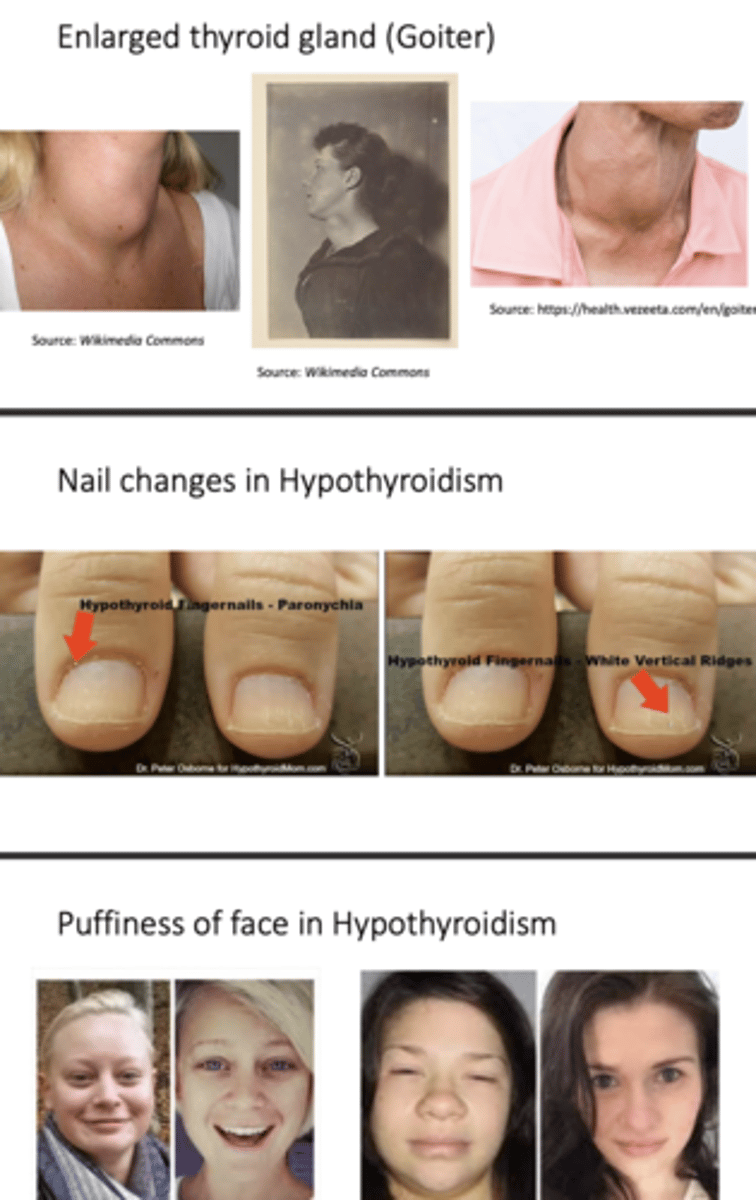 <p>Thin brittle nails</p><p>Thinning of skin</p><p>Pallor</p><p>Puffiness of face, eyelids</p><p>Thinning of outer eyebrows</p><p>Thickening of tongue</p><p>Peripheral edema</p><p>Pleural/peritoneal/pericaridal effusions</p><p>Decreased deep tendon reflexes</p><p>Myxedema heart</p><p>Bradycardia</p><p>Hypertension</p><p>Goiter</p>