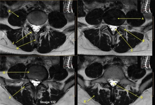 <p>Letter H in Image 132 is pointing to:</p><p>A. Lamina</p><p>B. Pedicle</p><p>C. Facet joint</p><p>D. Spinal canal</p><p>E. Spinous process</p>