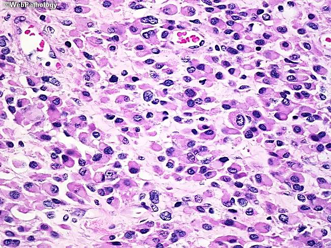 <p>Orbital rhabdomyosarcoma</p><p>N/E:</p><p>Rapidly progressive proptosis or rapidly enlarging orbital mass.</p><p>M/P:</p><p>The tumor cells have deeply esinophilic cytoplasm (sometimes with cytoplasmic striations), with hyperchromatic atypical nuclei and atypical mitosis.</p>