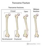 <p>a break that runs horizontal to your bone. A break all the way through</p>