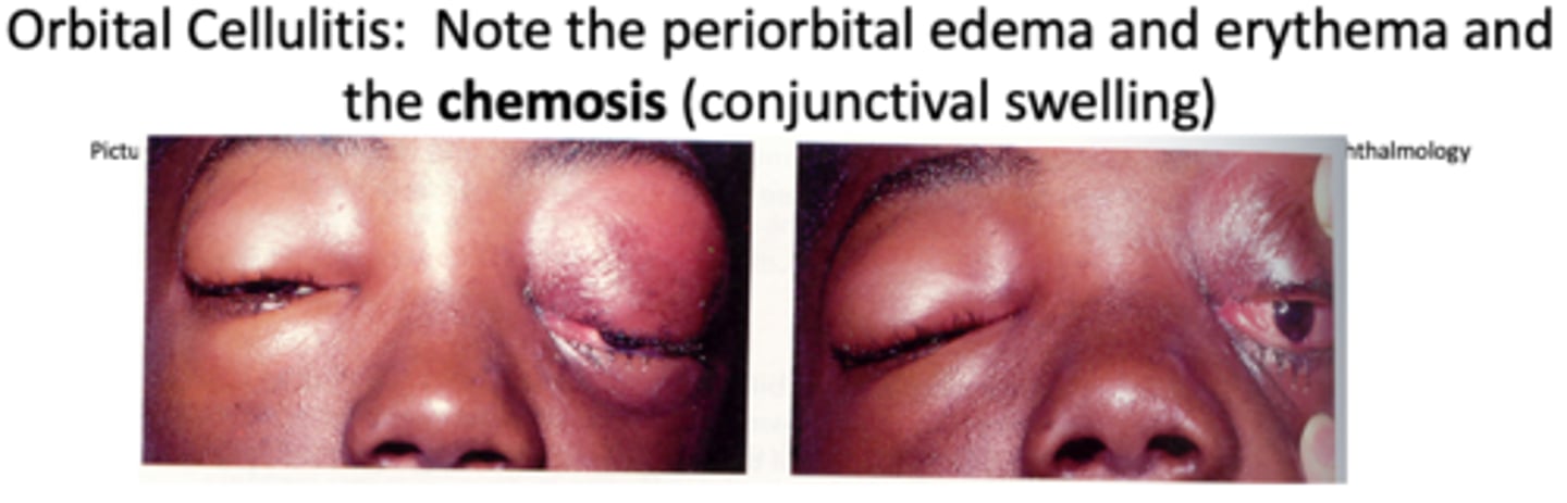 <p>Patients need to be admitted. Management includes ENT and ophthalmology consultation, starting empiric IV antibiotics (Vancomycin plus 3rd-generation cephalosporin or beta-lactamase resistant drug like piperacillin-tazobactam). Surgery may be indicated if there is no response to antibiotics or if an abscess is identified. Once the patient is improving and afebrile, oral antibiotics are continued for 2-3 weeks.</p>