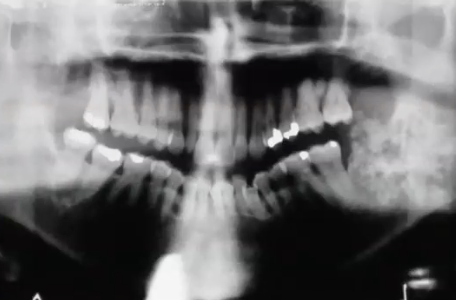 <p>What is this radiograph showing</p>