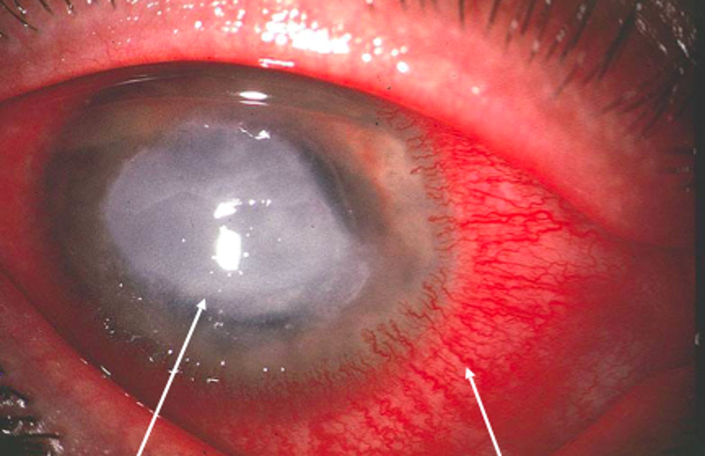 <p>The diagnostic finding in bacterial keratitis is a corneal opacity or infiltrate (typically a round white spot) in association with red-eye, photophobia, and foreign body sensation.</p>