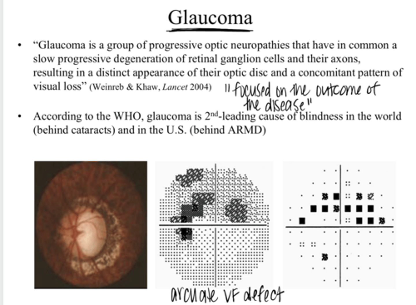 <p>What is the definition given for glaucoma?</p>