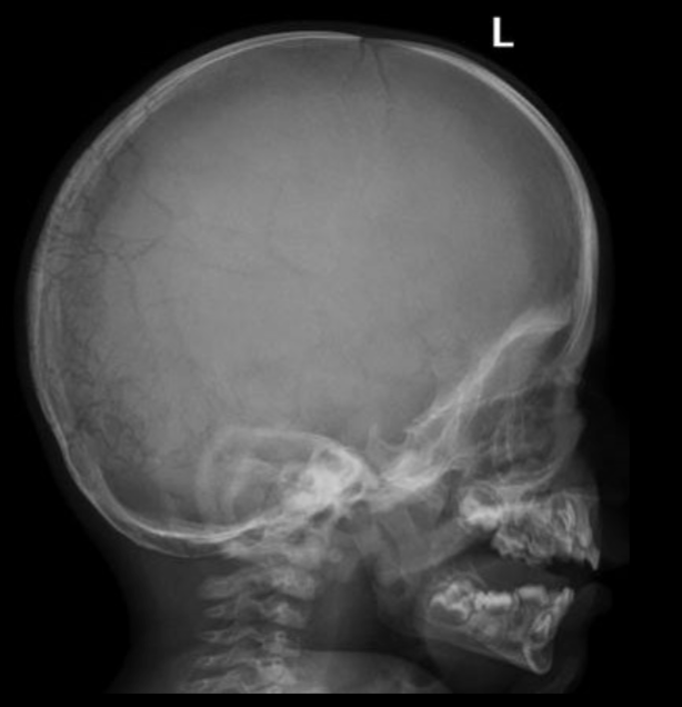 <p>what is seen here for this case of osteogenesis imperfecta?</p>