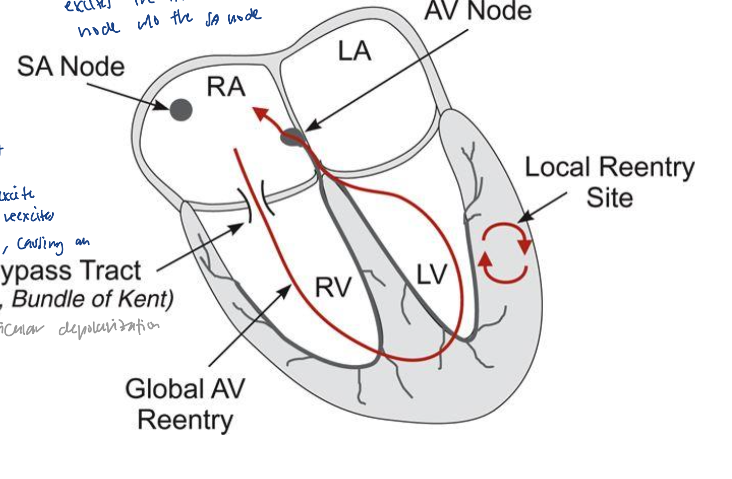 <ul><li><p>AV node is excited without the SA node</p></li><li><p>action potential goes to ventricles without the purkinje fibers, and goes via the bypass tract (bundle of kent). then, goes back up to reexcite the AV node</p></li></ul><p></p>
