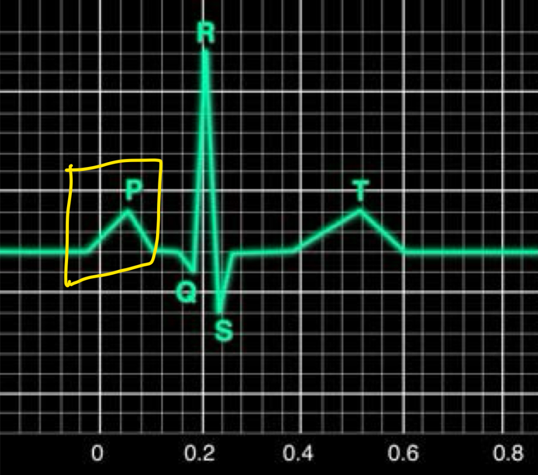<p>Atrial depolarisation</p><ul><li><p>SA nodes undergo depolarisation</p></li><li><p>Message goes to AV node</p></li><li><p>Message went through interatrial pathway</p><ul><li><p>Left/right atrium will contract soon</p></li></ul></li></ul>