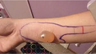 <p>•Bite injects a cytotoxin</p><p>•Cytotoxin -- toxic to cells</p><p>•Breaks down cell membranes leading to necrosis of the tissue</p><p>Not very painful when bite happens </p><p> may lead to amputation of bite area</p><p>•Not deadly</p><p>•Localized swelling (initially), tenderness</p><p>•Pale, mottled, cyanotic center w/possible blister formation</p><p>•Open sore &amp; necrosis (2 - 8 hrs)</p><p></p>