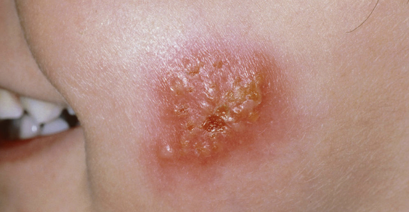 <p>bacterial skin infection categorized by isolated pustules that become crusted and rupture</p>