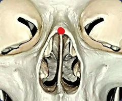 <p>Midline point at the inferior free end of the internasal suture</p>
