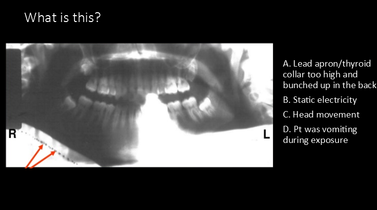 <p> What is this?</p><p>A. Lead apron/thyroid collar too high and bunched up in the back</p><p>B. Static electricity</p><p>C. Head movement</p><p>D. Pt was vomiting during exposure</p>