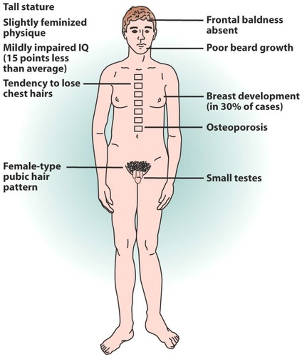 <p>Define Condition:</p><p>Type of PRIMARY Puberty condition - chromosomal abnormality in which a male is born with two X chromosomes and one Y chromosome</p><p>-Hx: 1 in 600 males</p><p>-Sx/PE:</p><p>&gt; Primary Gonadal Insufficiency</p><p>&gt; Small Testes</p><p>&gt; TALL STATURE</p><p>&gt; Eunuchoid Habitus (arms and legs are disproportionately long relative to the torso)</p><p>&gt; Gynecomastia</p><p>&gt; Learning Disabilities</p><p>-Dx:</p><p>Karyotype = CONFIRM</p><p>Labs</p><p>&gt; FSH/LH = HIGH</p><p>&gt; Test = Low(ish)</p><p>-Tx: Testosterone Replacement</p><p>-Prog:</p><p>&gt; Infertility</p><p>&gt; Breast cancer</p><p>&gt; Mediastinal germ cell. tumors</p>