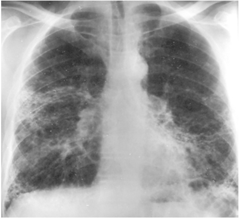 <p>77 y/o male presents to the clinic for worsening dyspnea. While collecting a history, he notes that he used to work construction back in the 80s. On a physical exam you note inspiratory crackles, digital clubbing and and cyanosis. CXR shows thickening/calcification along the parietal pleura and lower lung fields (diaphragm/cardiac border). What are you thinking?</p>