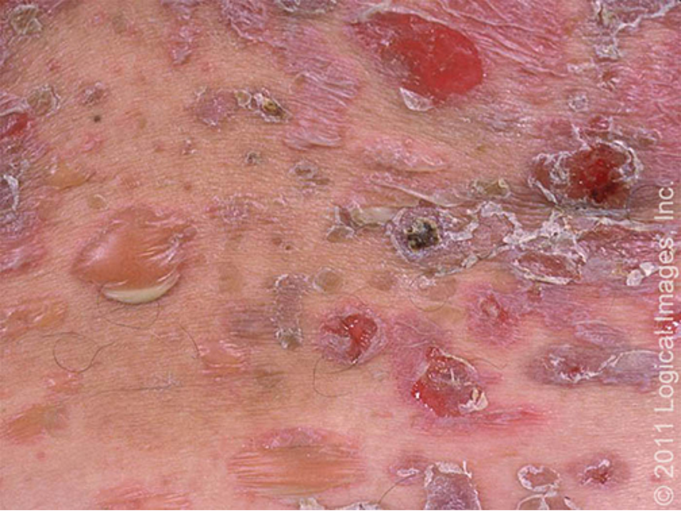 <p>rare autoimmune dz characterized by painful blisters and erosions on skin and mucous membranes; MC bt ages 40-60</p>