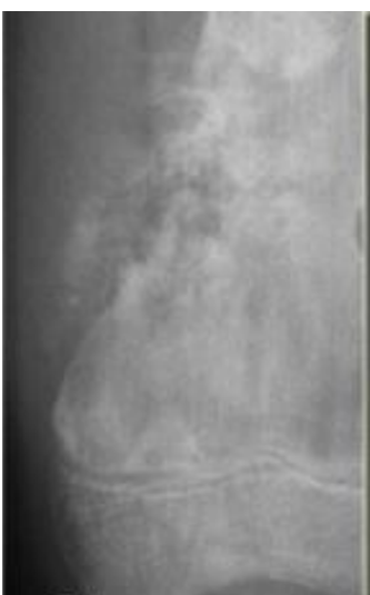 <p>Identify the type of tumour.</p>