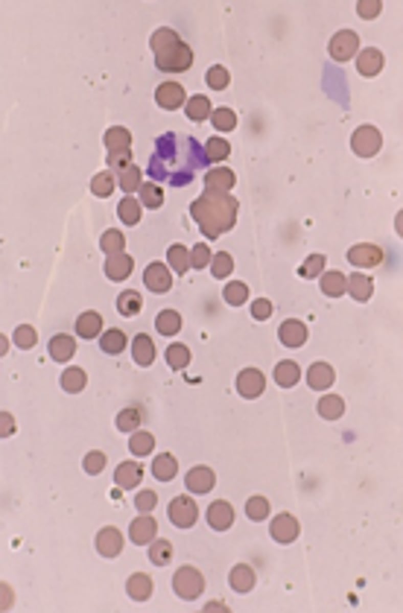 <p>§Immune-mediated haemolytic anaemia</p><p>§Mismatched blood transfusion</p>