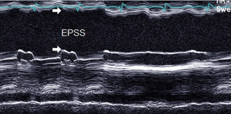 <p>Dilated cardiomyopathy</p>