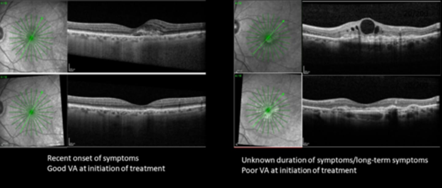<p>What is the referral and f/u timeline for treating CNV with anti-VEGF?</p>