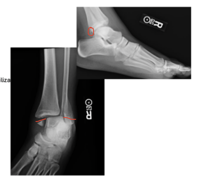 <p>A fracture of the medial malleolus and fibula AND the posterior malleoulus</p>