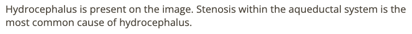 <p>b) aqueductal stenosis</p>