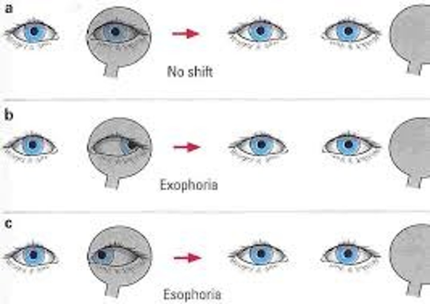 <p>Strabismus; movement of either eye indicates muscle imbalance resulting in strabismus</p>