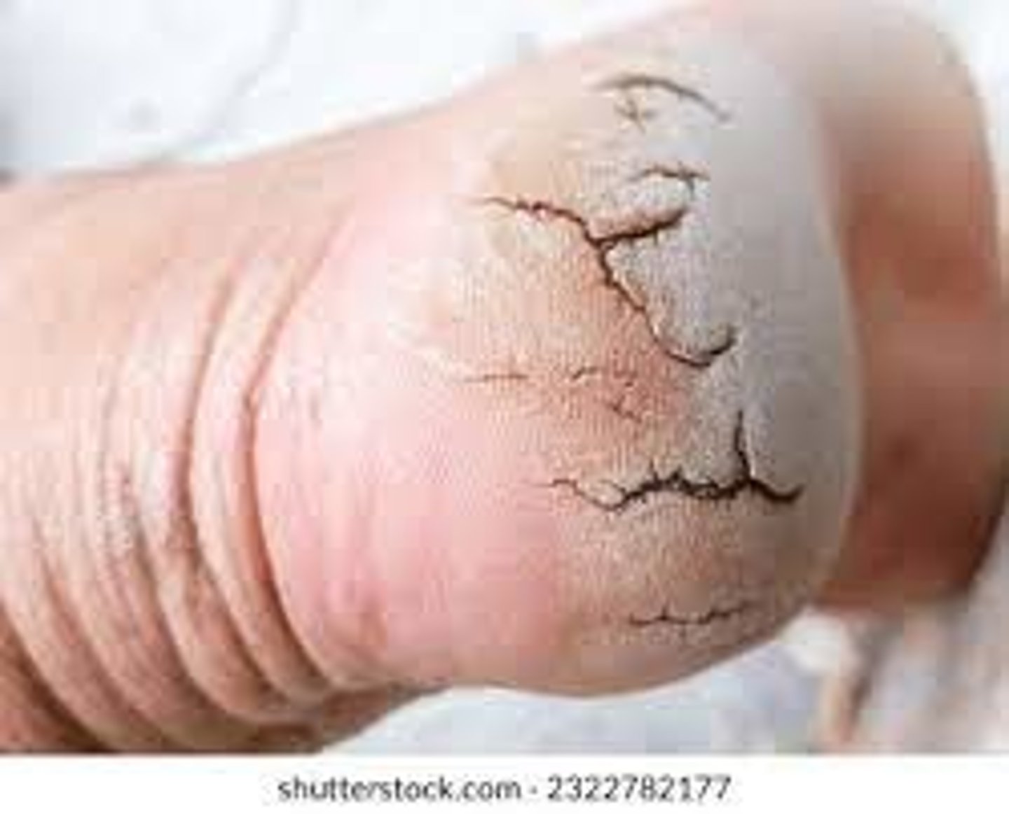 <p>Laceration in the skin</p>