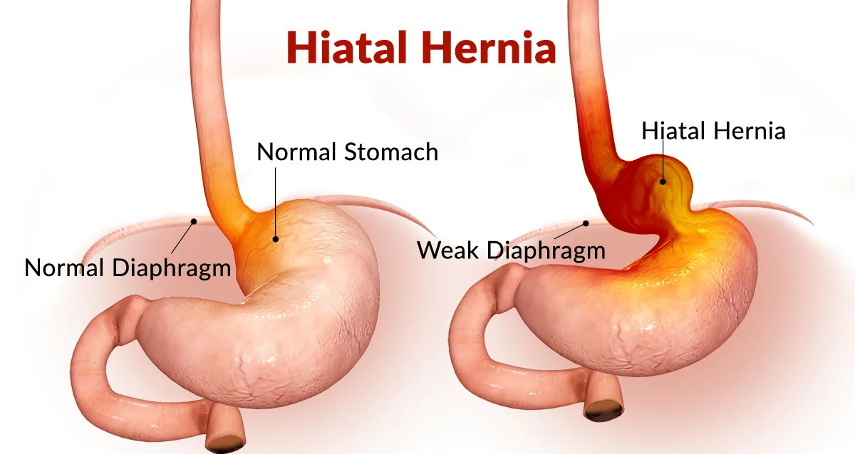 <p>Occurs when<strong> part of the stomach moves through the esophageal hiatus</strong> of the diaphragm into the chest.</p>