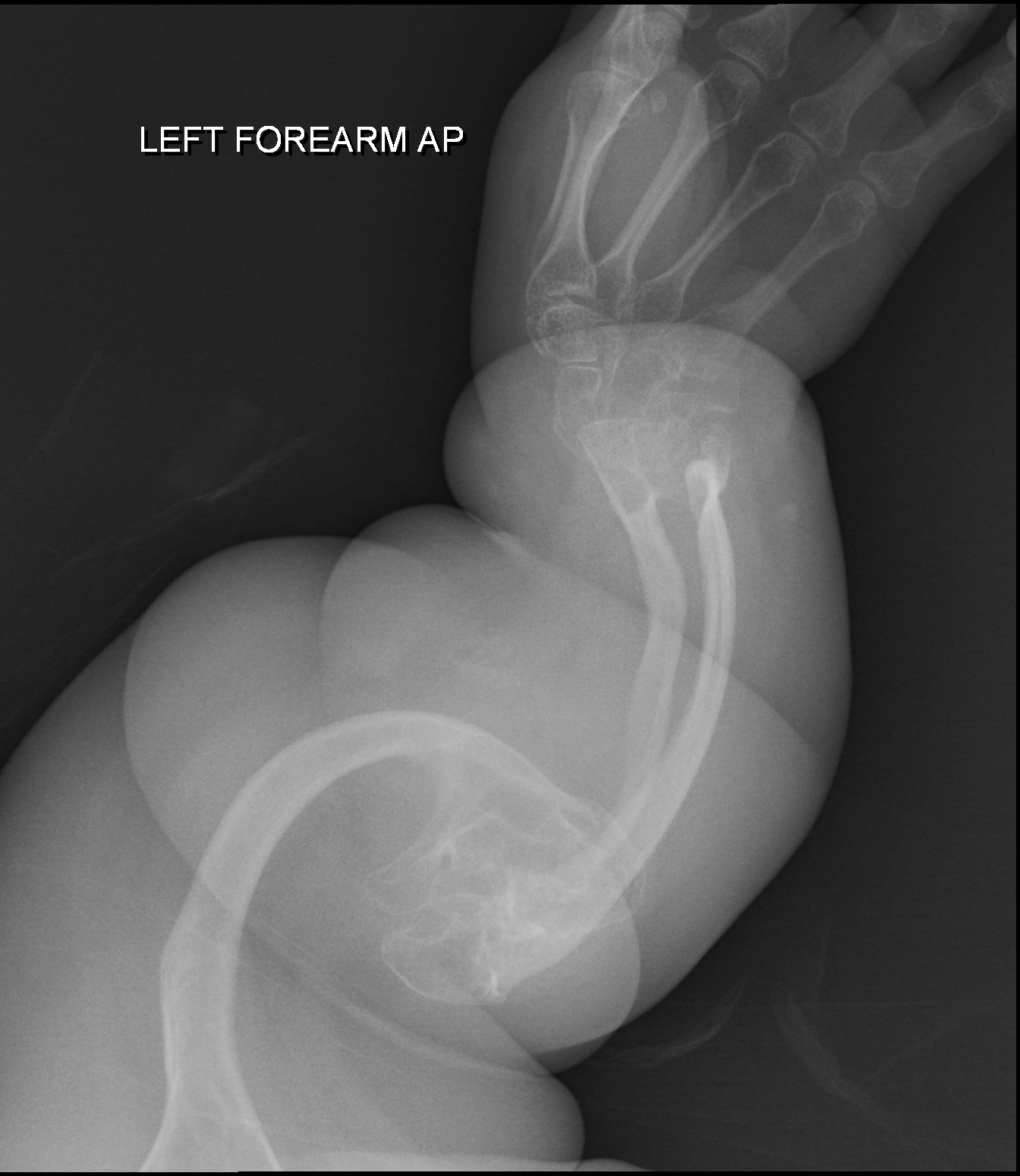 <p>Inherited generalized disorder of connective tissue characterized by multiple fractures and blue sclera (the white of the eye) - patients suffer repeated fractures caused by the severe osteoporosis and the thin, defective cortices.</p>