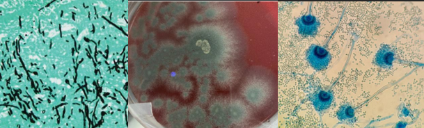 <p><span style="font-family: &quot;Times New Roman&quot;, serif; line-height: 107%;"><span>Classical association: bovine abortion; nasal aspergillosis in dogs</span></span></p><p class="MsoListParagraphCxSpMiddle"><span style="font-family: &quot;Times New Roman&quot;, serif; line-height: 107%;"><span>Histology: septate, parallel walls, 45° dichotomous branching</span></span></p><p class="MsoListParagraphCxSpMiddle"><span style="font-family: &quot;Times New Roman&quot;, serif; line-height: 107%;"><span>Culture: powdery/velvety mould</span></span></p><p class="MsoListParagraphCxSpLast"><span style="font-family: &quot;Times New Roman&quot;, serif; line-height: 107%;"><span>Microscopy: conidiospores</span></span></p><p class="MsoListParagraphCxSpLast"><span style="font-family: &quot;Times New Roman&quot;, serif; line-height: 107%;"><span>What is it?</span></span></p>