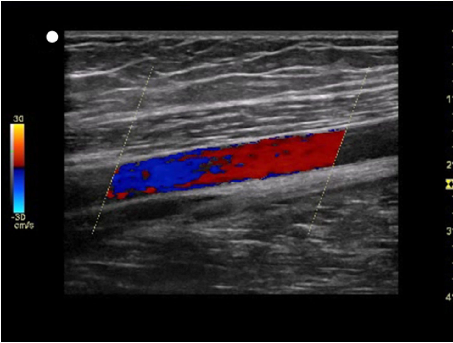<p>Demonstrates presence of blood flow with color</p>