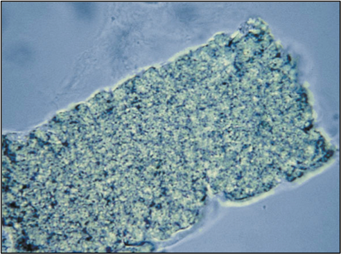This casts is a hyaline matrix with coloration due to pigment incorporation
