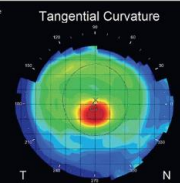 <ul><li><p>can detect subtle differences in curvature </p></li><li><p>early diagnosis</p></li><li><p>monitoring progression</p></li></ul>