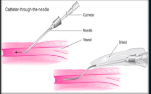 Plastic catheter mounted on metal needle; 10 – 27g, .75” - 3” length; used for more long term therapy