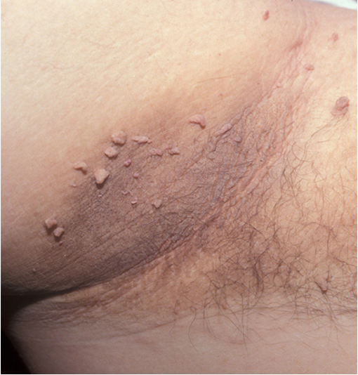 <p>sickened, <strong>velvety</strong> to verrucous, grey brown plaques; skin tags may be present</p><p>location: intertriginous areas (neck and axilla common)</p>