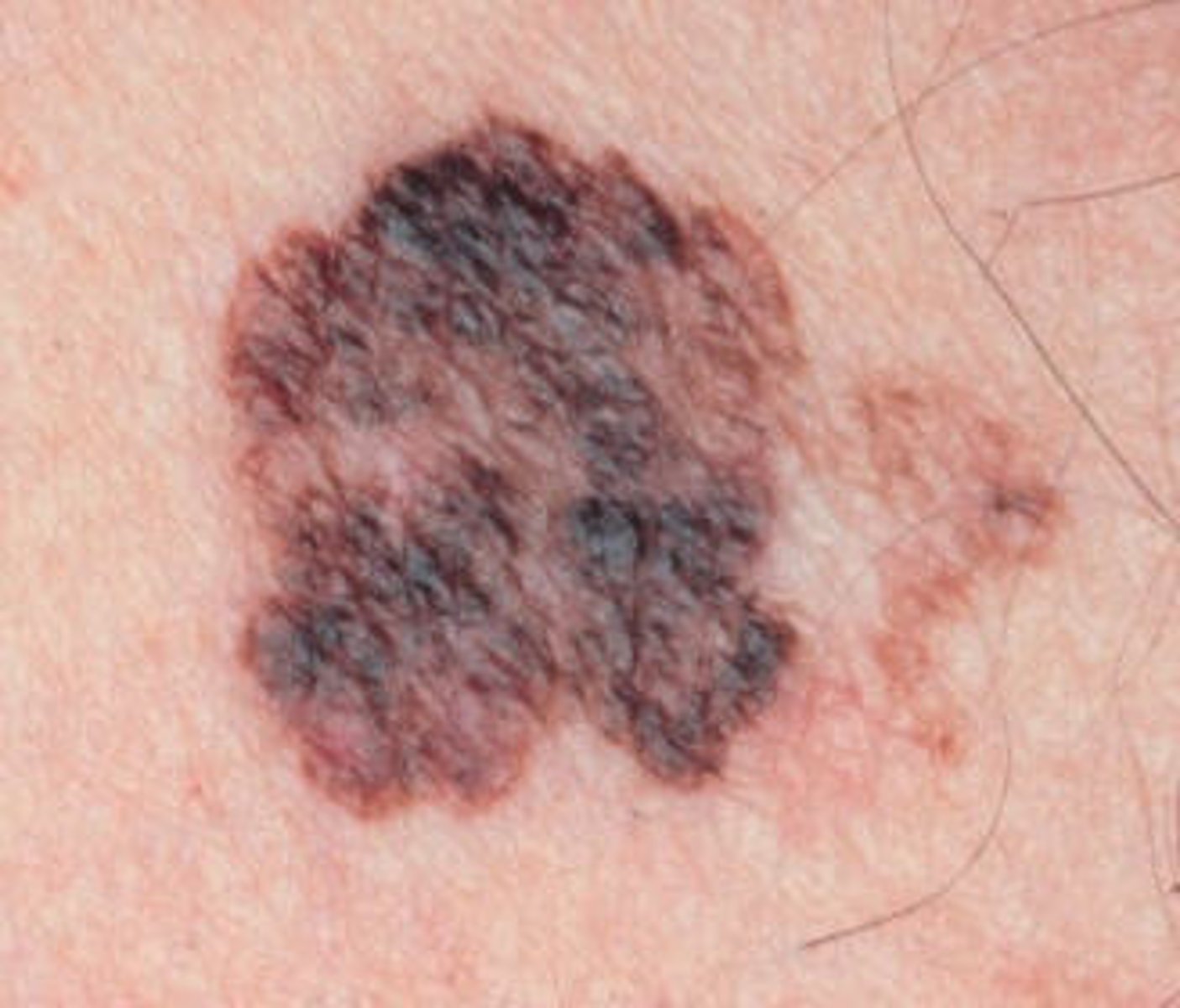 <p>Dysplastic Nevi</p>