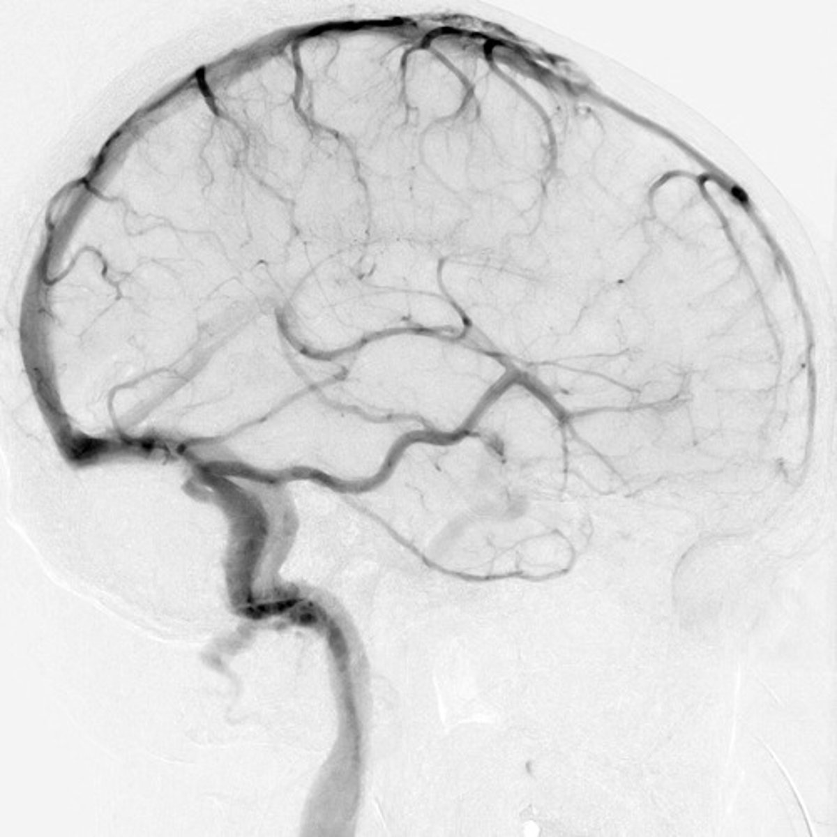 <p>x-ray imaging of blood vessels after injection of contrast material</p>