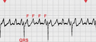 Multiple waves prior to a QRS complex. No P waves.