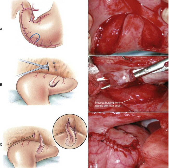 <p>Seromuscular flap pulled through abdominal wall muscle layer &amp; fixed</p>
